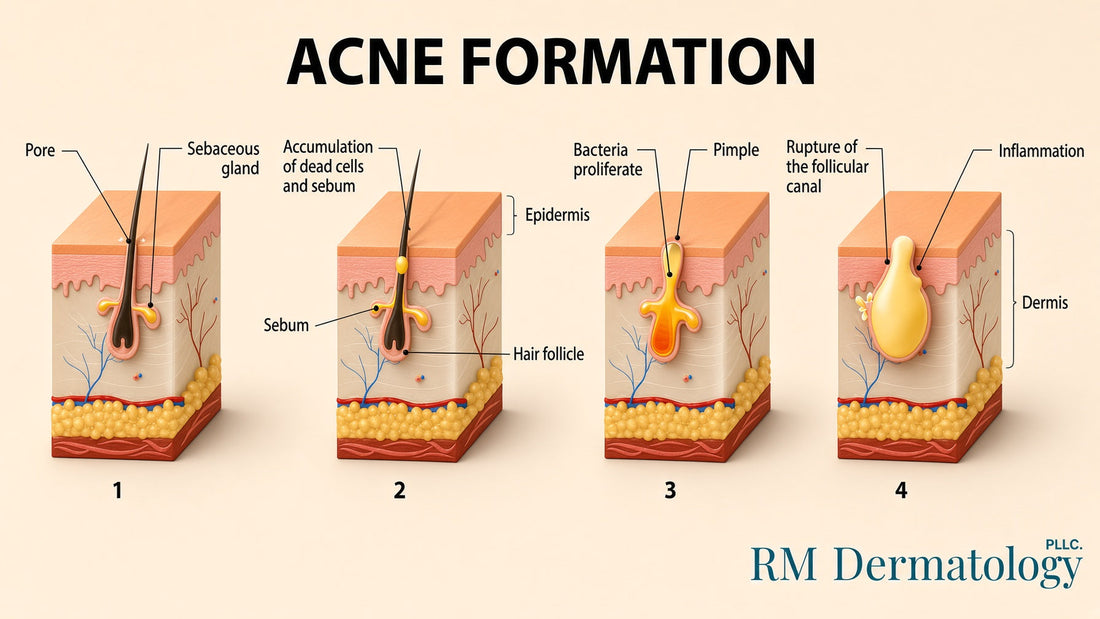 Acne: Beyond the Myth of a Single Cause or Cure