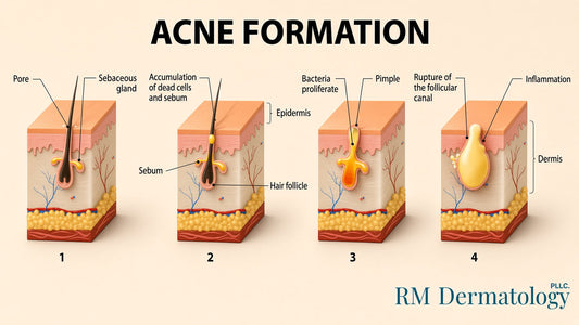Acne: Beyond the Myth of a Single Cause or Cure
