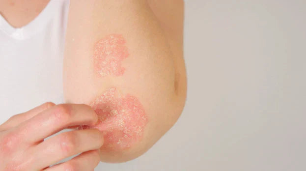 Psoriasis