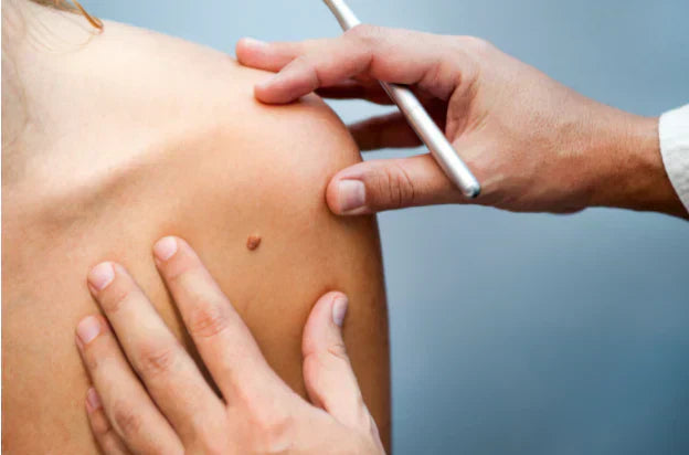 Skin Cancer